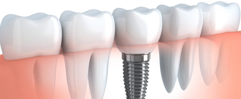 Las preguntas más frecuentes que hacen los pacientes ante un tratamiento con Implantes dentales (2ª Parte)
