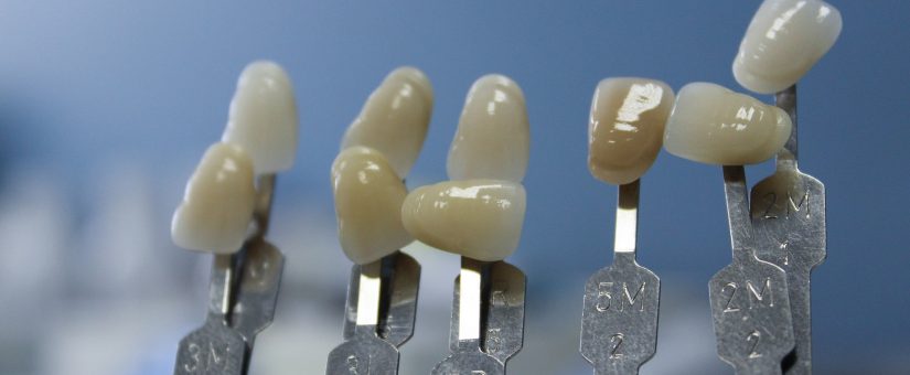Las preguntas más frecuentes que hacen los pacientes ante un tratamiento con Implantes dentales. Parte III