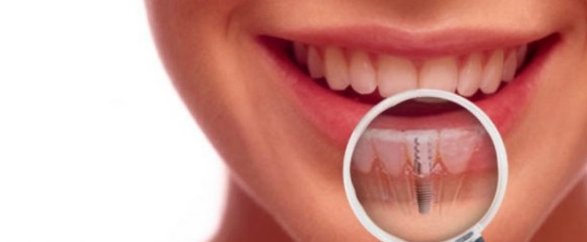 Las preguntas más frecuentes que hacen los pacientes ante un tratamiento con Implantes dentales. Parte IV