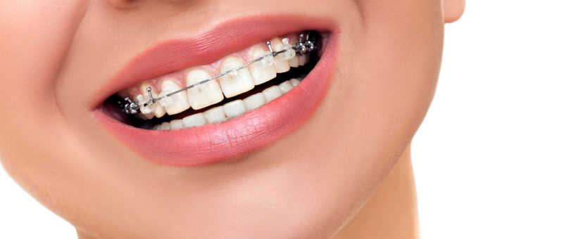 ¿Cuándo es el mejor momento para empezar a tratar con ortodoncia?
