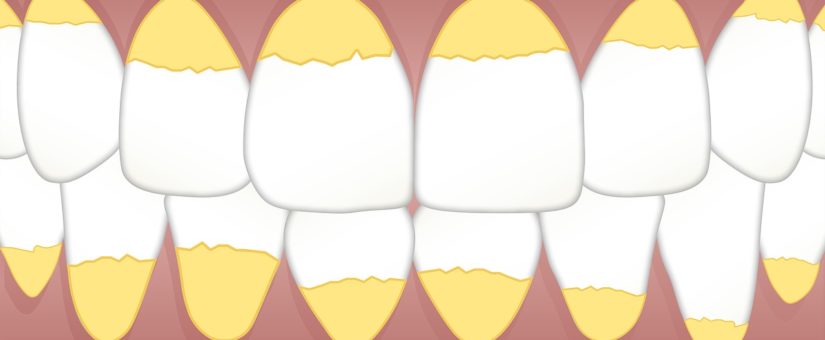 Sarro dental: qué es y cómo evitarlo