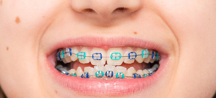 Los múltiples beneficios de una ortodoncia infantil