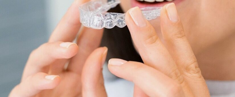 Diferencias entre Ortodoncia Invisible e Invisalign