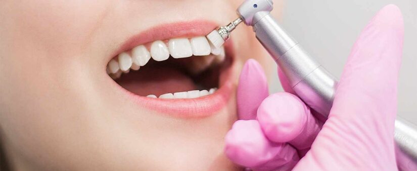 ¿En qué consiste un blanqueamiento dental?