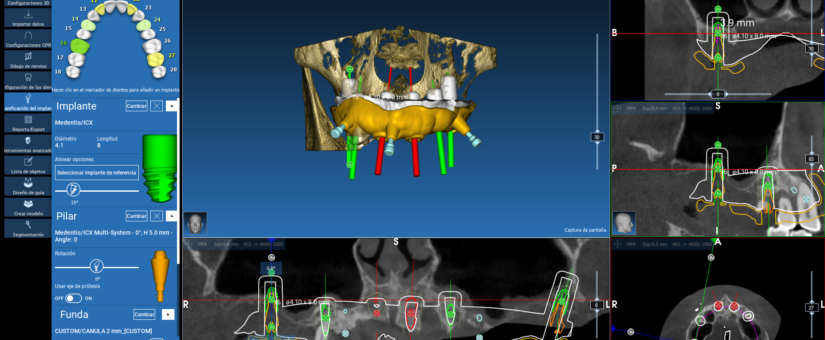 Cirugía Guiada en Implantes Dentales: Un Camino hacia una Recuperación más Suave y Confortable