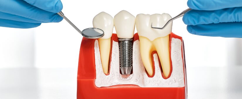 Implante o puente dental ¿Qué opción es mejor?