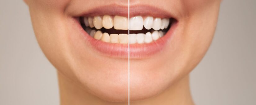 Consejos para prolongar la duración de tu blanqueamiento dental