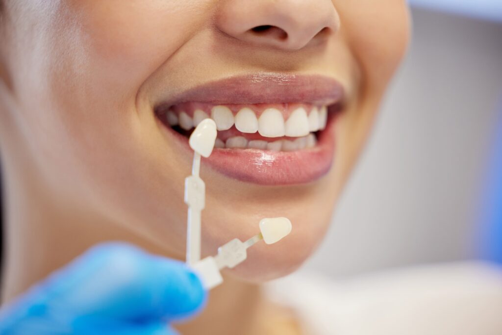 Resultados visibles de blanqueamiento dental profesional