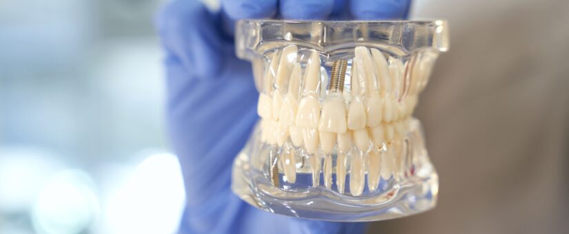 Preguntas frecuentes sobre implantes dentales