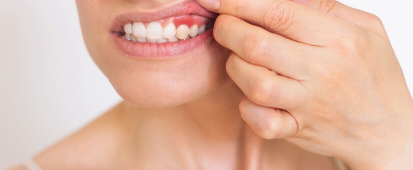 ¿Cuál es el tratamiento para las encías inflamadas?