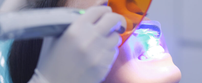 Blanqueamiento dental: todo lo que debes saber antes de empezar