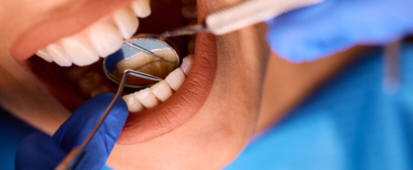 Limpieza dental profesional: por qué hacerla dos veces al año marca la diferencia